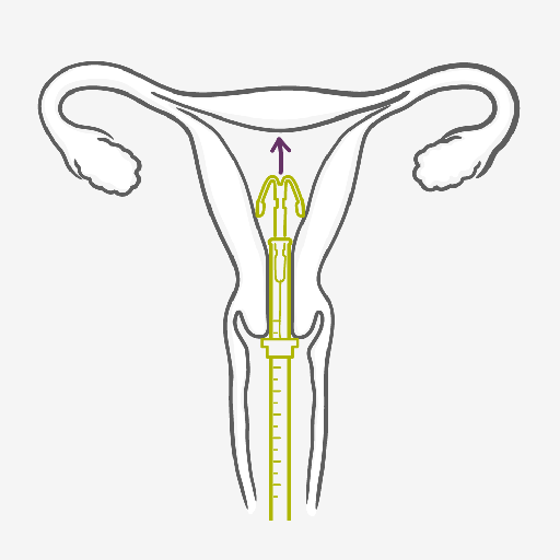 How does the Intrauterine System work