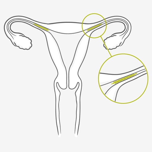 Sterilization