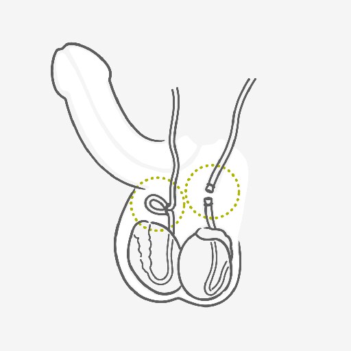 How does Sterilization work
